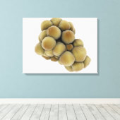 腫瘍の顕微鏡的見解5 キャンバスプリント (インサイチュ (ウッドフロア))