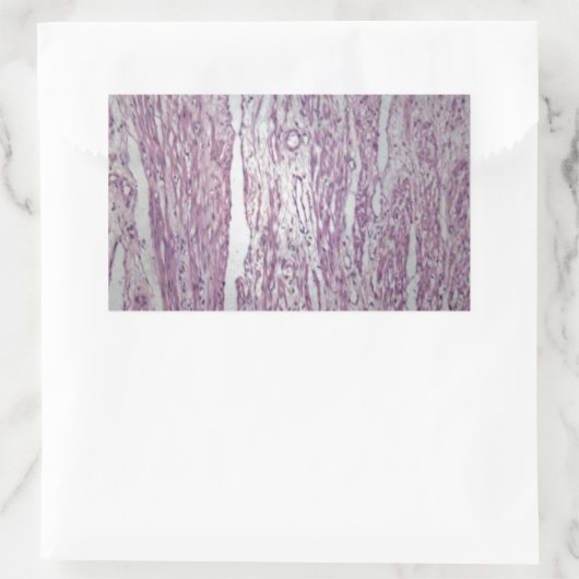 腫瘍内浸潤を伴うヒト子宮組織の細胞 長方形シール (バッグ)