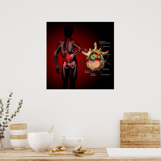 腰痛 ポスター (キッチン)