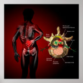 腰痛 ポスター (正面)