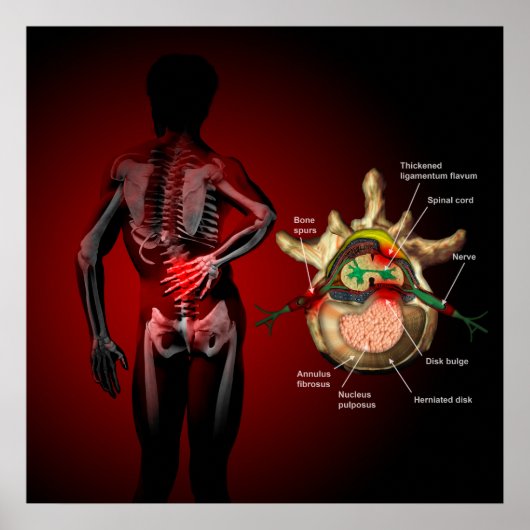 腰痛 ポスター (正面)