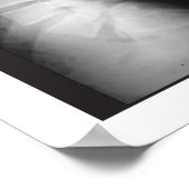 腰部スペインの脊髄変性ポスター ポスター (角)