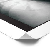 腰部脊髄変性ポスター ポスター (角)