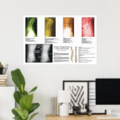 腰部脊髄変性ポスター ポスター (ホームオフィス)