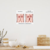 腹部大動脈瘤ポスター ポスター (キッチン)