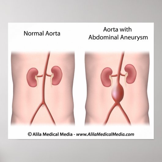 腹部大動脈瘤ポスター ポスター (正面)