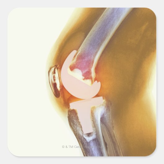 膝の交換。全膝の色のX線 スクエアシール (正面)