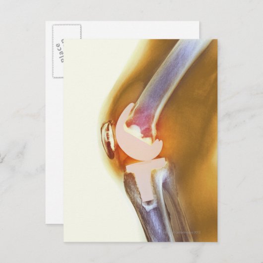 膝の交換。全膝の色のX線 ポストカード (正面/裏面)