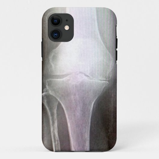 膝のX線IPHONEカバー Case-Mate iPhoneケース (裏面)