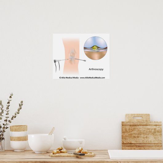 膝関節鏡下図。 ポスター (キッチン)
