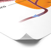 良性前立腺過形成ポスター ポスター (角)