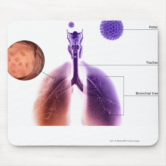 花粉からの喘息の発作のイラストレーション マウスパッド (正面)