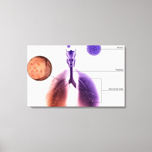 花粉による喘息発作イラストレーション キャンバスプリント (正面)