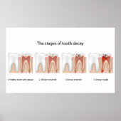 虫歯ポスター ポスター (正面)