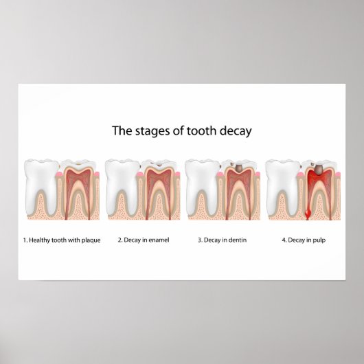 虫歯ポスター ポスター (正面)
