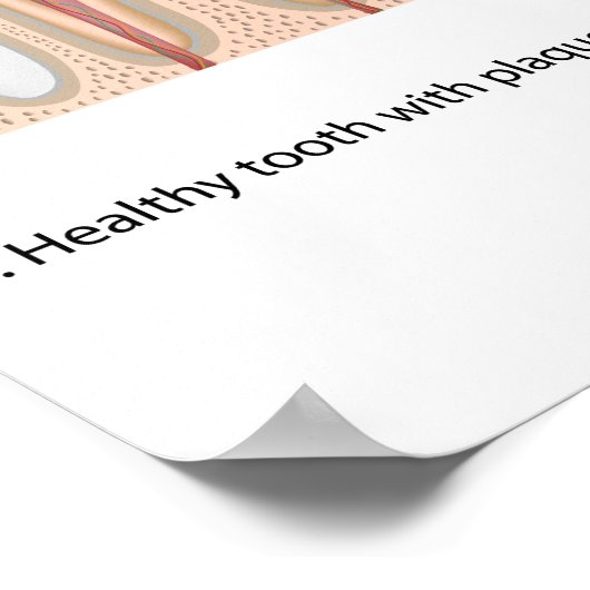 虫歯ポスター ポスター (角)