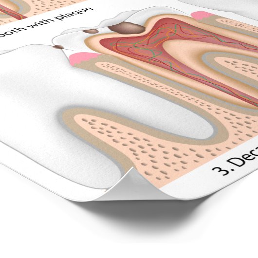 虫歯ポスター ポスター (角)