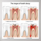 虫歯ポスター ポスター (正面)