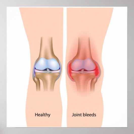 血友病のポスターの共同出血 ポスター (正面)