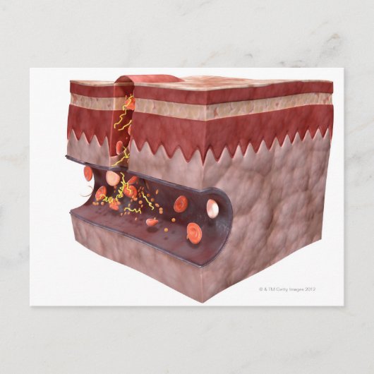 血栓の形成 ポストカード (正面)