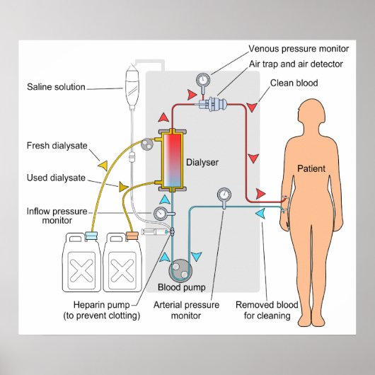 血液透析医療トリートメント図 ポスター (正面)