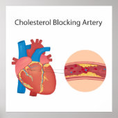 血管の狭窄 ポスター (正面)