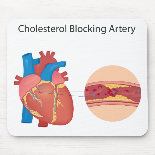 血管の狭窄 マウスパッド (正面)