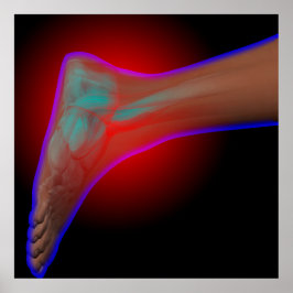 足首の痛み ポスター