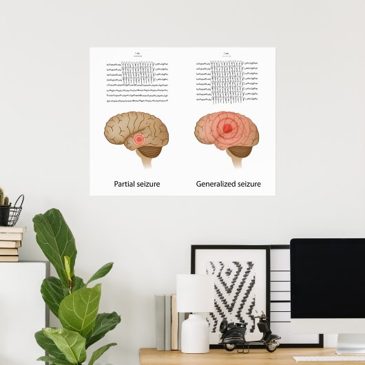 部分的および一般化てんかんポスターの脳波 ポスター (ホームオフィス)