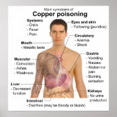 銅中毒の主な症状表 ポスター (正面)