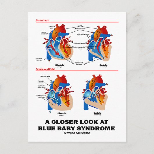 青い赤ちゃん症候群(心臓)についての詳細な解説 ポストカード (正面)