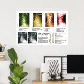 頸部脊髄変性ポスター ポスター (ホームオフィス)