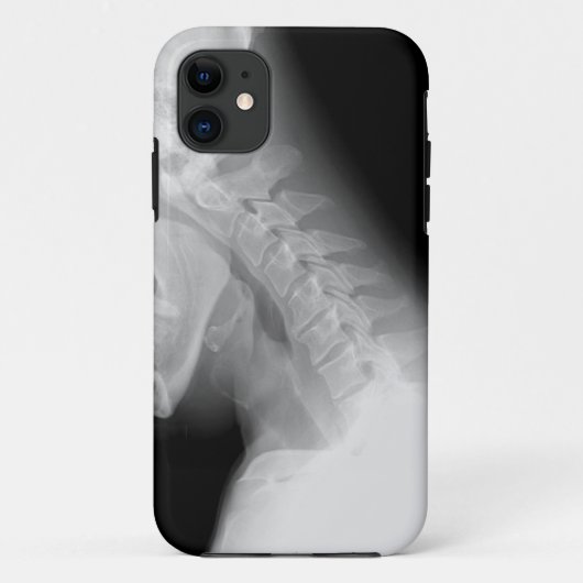 顎および脊柱X光線のIPhoneの場合 Case-Mate iPhoneケース (裏面)
