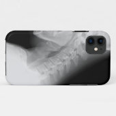 顎および脊柱X光線のIPhoneの場合 Case-Mate iPhoneケース (裏面(横))
