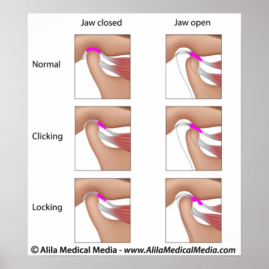 顎関節機能障害、TMJまたはTMD ポスター (正面)