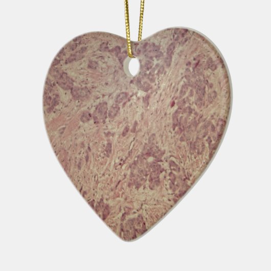 顕微鏡の下の乳癌 セラミックオーナメント (左)