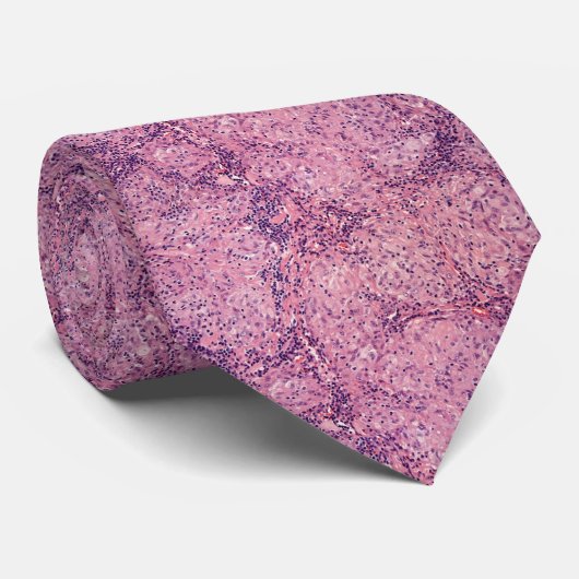 類肉腫症 ネクタイ (ロール)