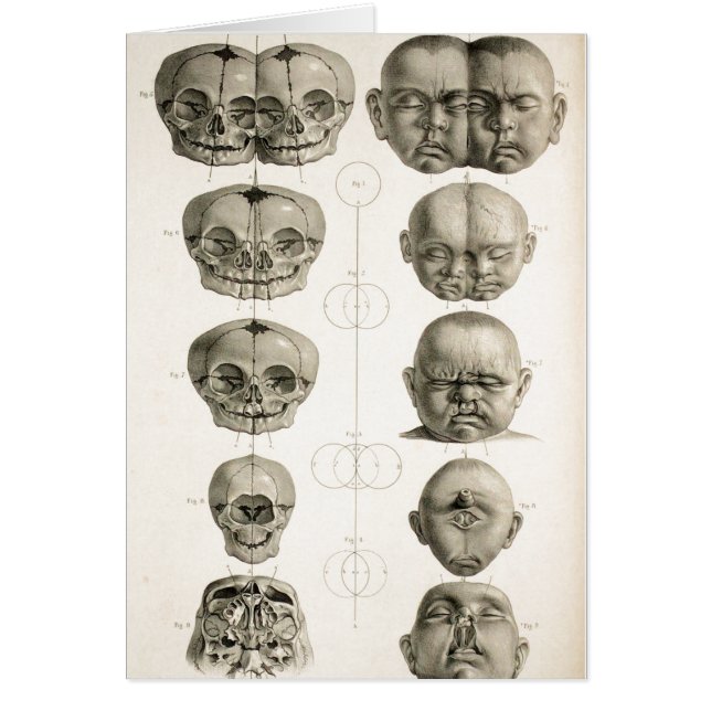 風変わりな幼児スカルの醜状はまたはベビーを合接します (正面)