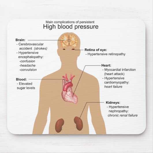 高血圧の図表の主要な複雑化 マウスパッド (正面)