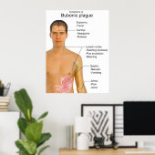 黒死腺ペスト表の主な症状 ポスター (ホームオフィス)