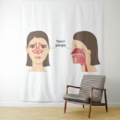 鼻ポリープ タペストリー (インサイチュ)