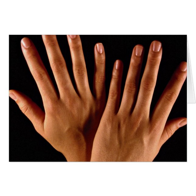 2つの交差させた手 (正面横)