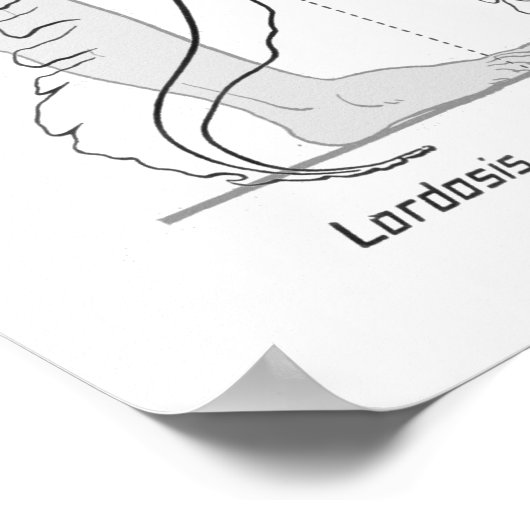 Abnormal Curves of the Spine Poster Chiropractic ポスター (角)