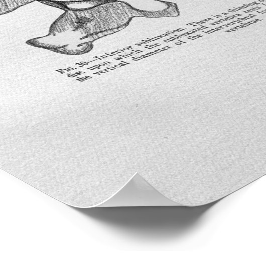 Chiropractic Vertebral Subluxation Vintage Print ポスター (角)