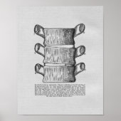Chiropractic Vertebral Subluxation Vintage Print ポスター (正面)