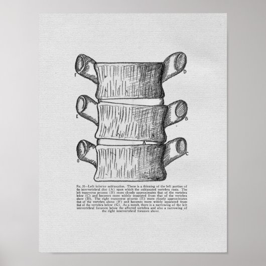 Chiropractic Vertebral Subluxation Vintage Print ポスター (正面)