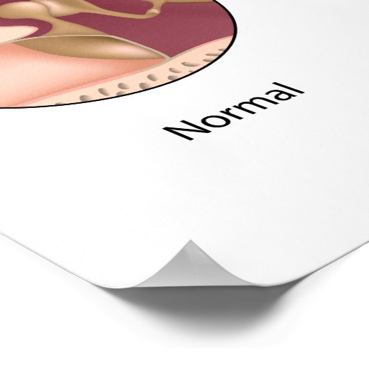 Cholesteatoma middle ear tumor Poster ポスター (角)