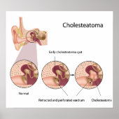 Cholesteatoma middle ear tumor Poster ポスター (正面)
