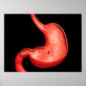 Conceptual Image Of Peptic Ulcer In Stomach ポスター (正面)