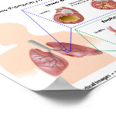 COPD肺疾患図 ポスター (角)